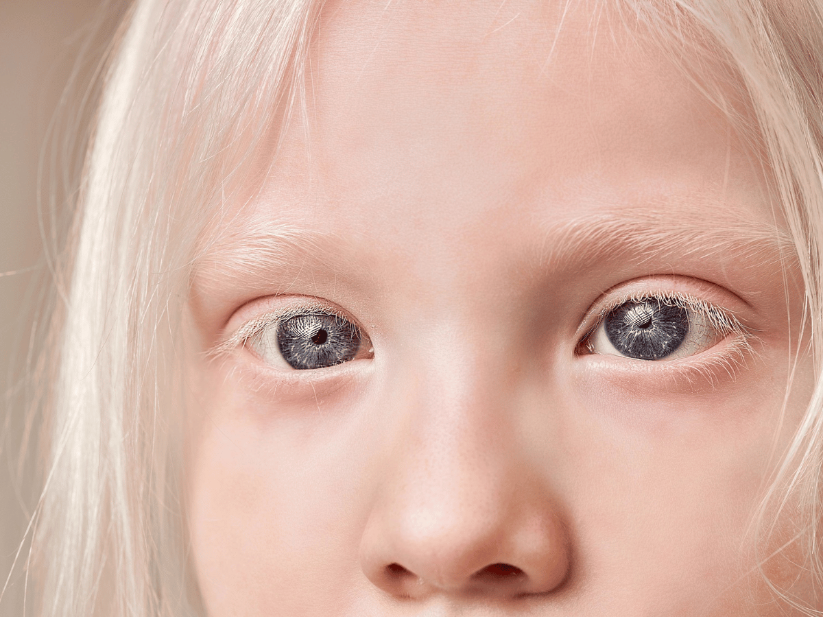 bambino albino cosa sapere dalla nascita alla crescita - OrizzonteNascita